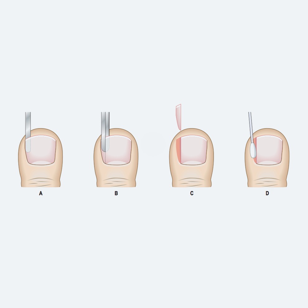 Removal of ingrown toenail surgery (Wedge Resection)