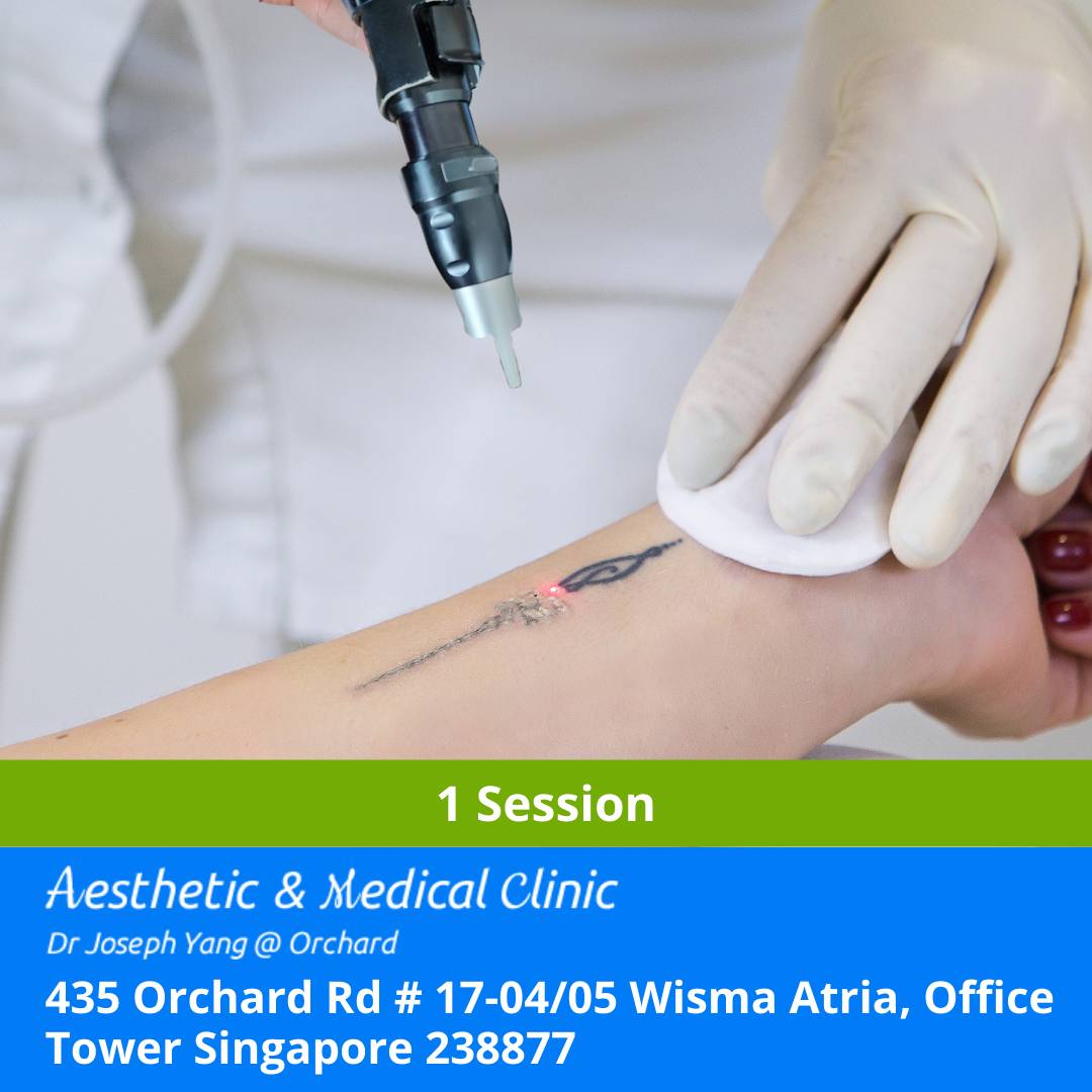 TATTOO LASER REMOVAL - PICOSURE (1 SESSION)
